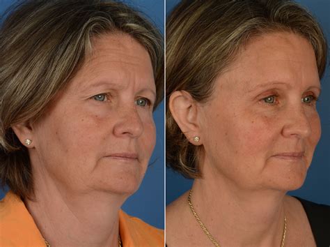 Blepharoplasty Photos | Naples, FL | Patient 11796