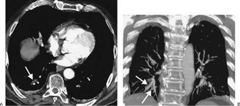 Pulmonary Vasculature Disease Chest Radiology The Essentials 2nd