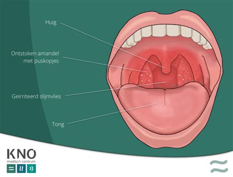 Ontstoken Amandelen Tonsillitis KNO MEDISCH CENTRUM