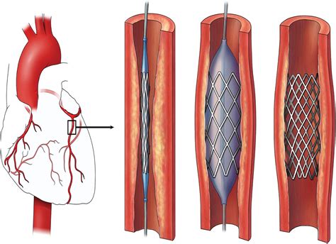 Angioplasty Understanding The Procedure Risks And Recovery DocOPD