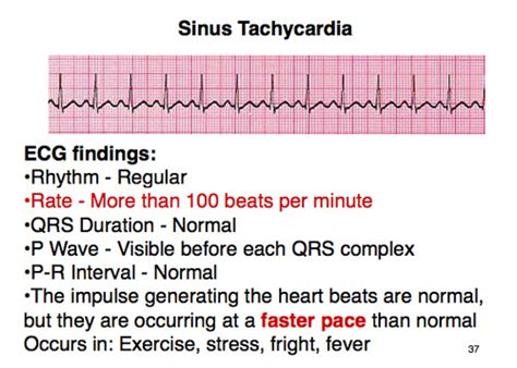 Reentry Supraventricular Tachycardia Acls