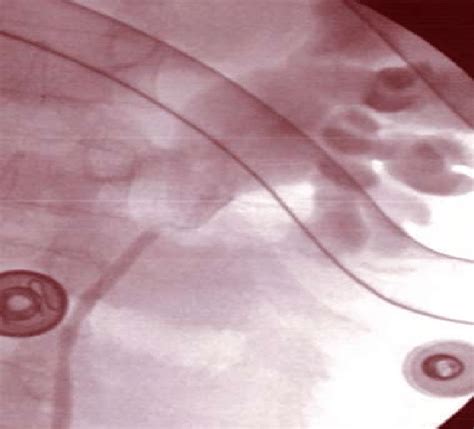 Retrograde pyelography showing | Download Scientific Diagram