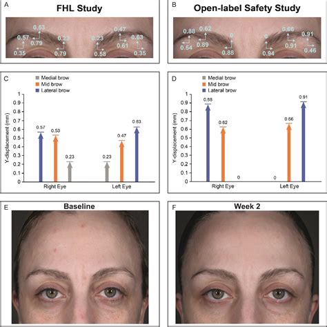 Figure 1 From Impact Of Daxibotulinumtoxina For Injection On Brow Position And Frontalis Muscle