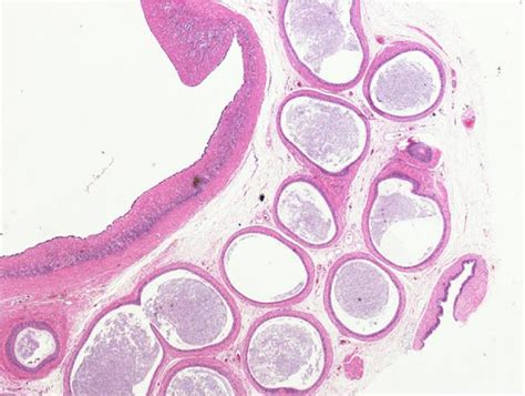 Serous Cystadenoma Of The Epididymis Urology