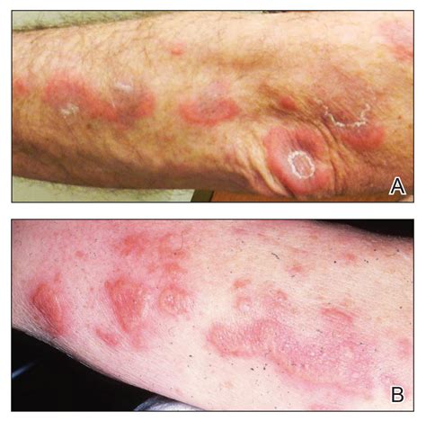 Sweet Syndrome With Pulmonary Involvement Preceding The Development Of Myelodysplastic Syndrome