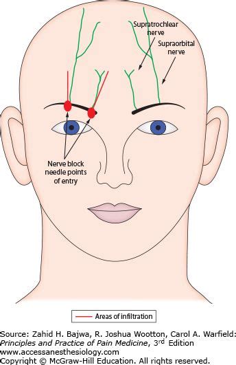 supraorbital nerve block - Google Search | Supraorbital nerve, Nerve ...