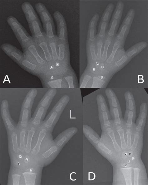 Time Of Appearance Of Ossification Centers In Carpal Bones Saudi