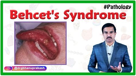 Behcets Syndromebehcet Disease Etiology Pathogenesis Clinical Features Diagnosis