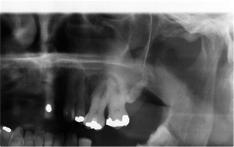 Unusual Finding Of Concrescence Bmj Case Reports