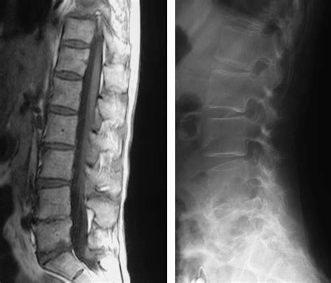 Radiological Features Of Lumbar Spinal Lesions In Patients With Rheumatoid Arthritis With