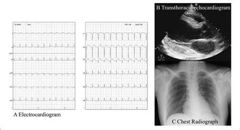 Electrocardiographic Transthoracic Echocardiogram And Chest