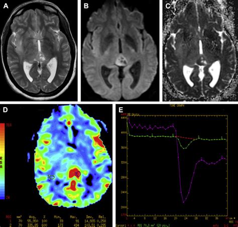 Pineal Region Masses In Pediatric Patients Neuroimaging Clinics