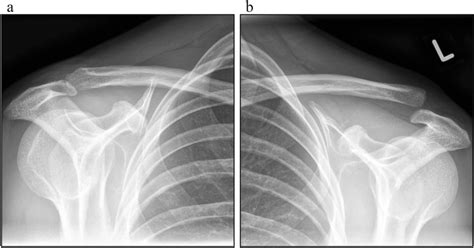 Arthroscopic Low Profile Reconstruction For Acute 48 Off