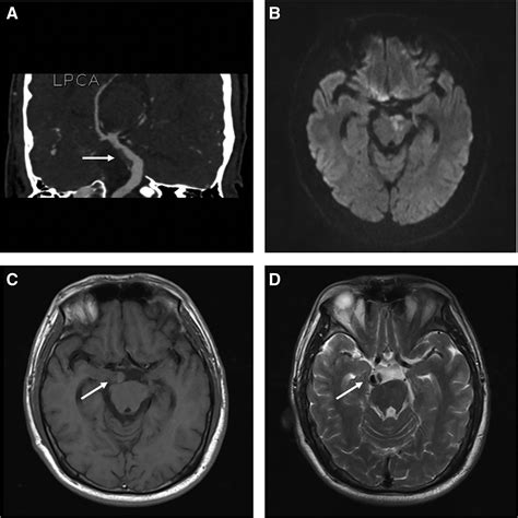 Acute Basilar Artery Occlusion Induced By Rapidly Progressive Thrombosis In Vertebrobasilar