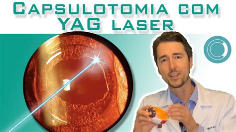 Capsulotomia Yag Laser Limpeza Da Lente Intraocular Youtube