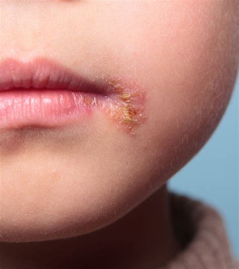 Impetigo In Children Symptoms Treatment And Prevention