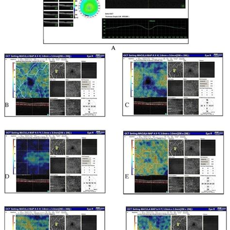 Optical Coherence Tomography Of The Right Eye Showing Broad Download Scientific Diagram