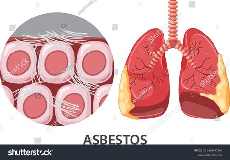 Asbestosis On Human Lungs Illustration Stock Vector Royalty Free