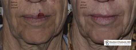 Before And After Mohs Surgery Upper Lip Infoupdate Org