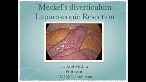 Meckel S Diverticulum Laparoscopic Resection Dr Atul Mishra