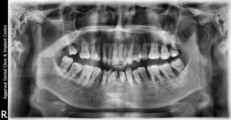 Full Mouth Fixed With Osstem Implants At Aggarwal Dental Clinic Jalandhar