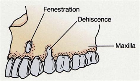 Alveolar Bone Flashcards Quizlet