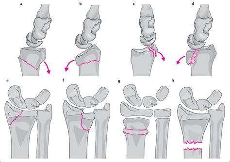 17 Trauma Of The Distal Forearm Radiology Key