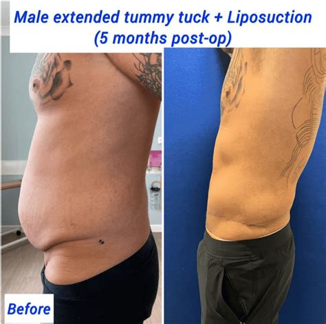 Liposuction Gone Wrong Men