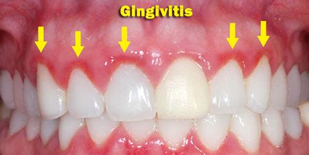 La gingivitis Síntomas causas y cómo prevenirla Amor Cristianoo