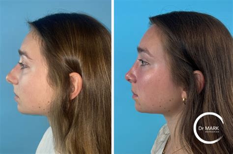 Rhinoplasty Before And After Images Dr Markarian