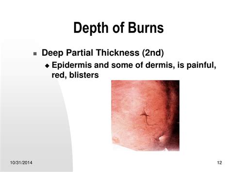 Ppt Burns Powerpoint Presentation Free Download Id6021518