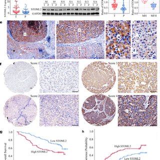 STOML2 Expression Is Upregulated In HCC Tissues And Predicts A Poor