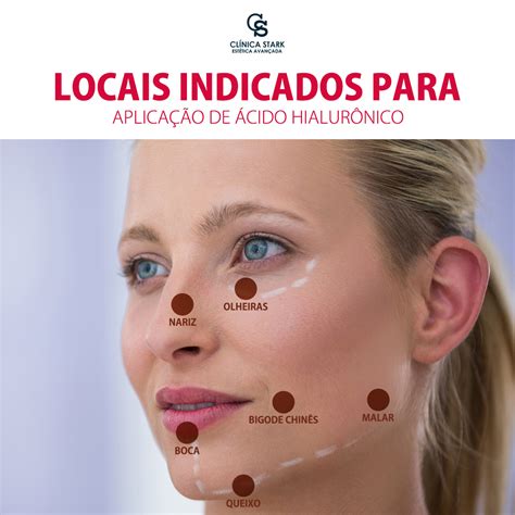 Preenchimento x Botox Entenda a diferença entre eles de uma vez por todas