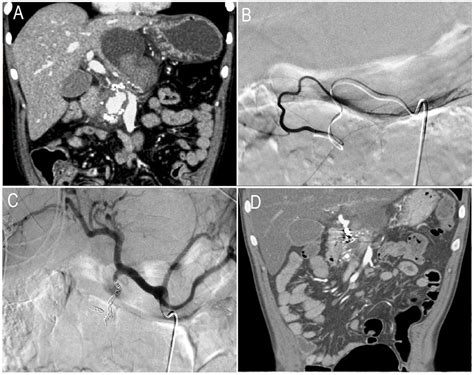 HEMOSUCCUS PANCREATICUS FROM GASTRODUODENAL ARTERY PSEUDOANEURYSM