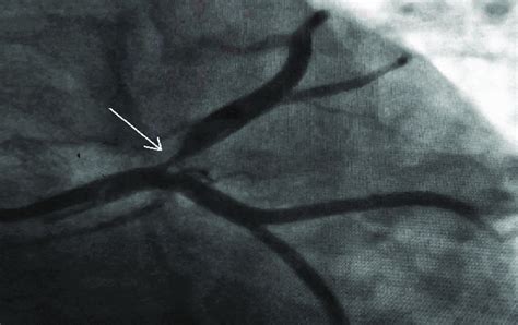 Coronary Angiography Right Anterior Oblique Caudal View Shows