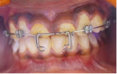 Orthodontic Extrusion Completed Download Scientific Diagram