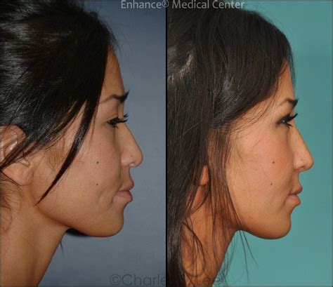 Asian Nasal Bridge Using All Natural Tissue Without Rib Enhance