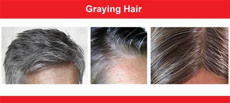 Hair Greying Premature Greying