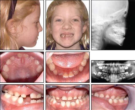 Early Treatment Of Skeletal Class Iii Open Bite With The Tandem Appliance Jco Online Journal