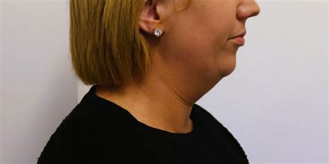 Double Chin Options Castleknock Cosmetic Clinic