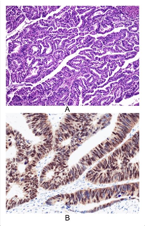 A Hematoxylin And Eosin Hande Stained Sections Of Case Number 6 Shows