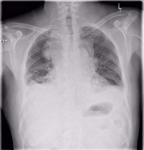 Non Hodgkin Lymphom Doccheck