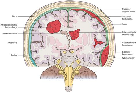 Brain Hemorrhage Varicose Veins Vascular Surgeon Stroke Dvt