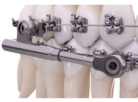 American Orthodontics Offers Class Ii Corrector Orthodontic Products