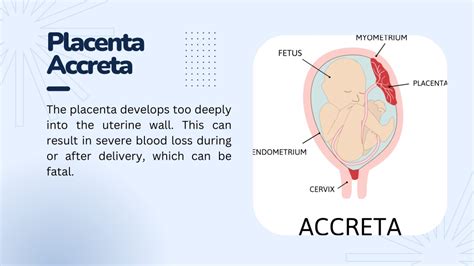 PPT - Complications of The Placenta PowerPoint Presentation, free ...