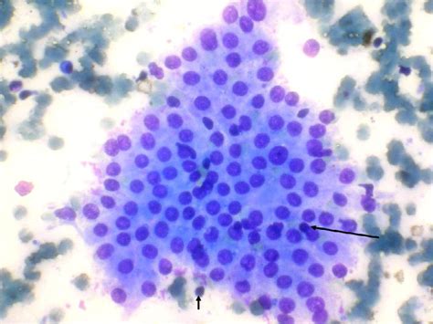 Lymphocytic Thyroiditis Is Cytological Grading Significant A Correlation Of Grades With