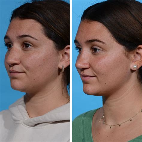 Rhinoplasty Dr Jeffrey Lisiecki