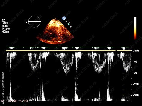 Screen of echocardiography (ultrasound) machine. Stock Photo | Adobe Stock