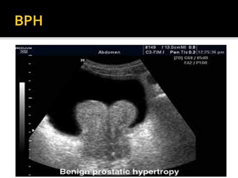 Benign Prostatic Hypertrophy Ultrasound