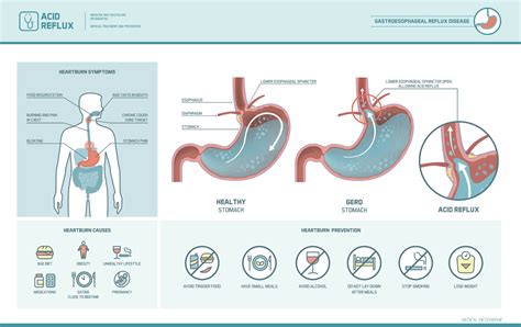 How to treat GERD naturally: 6 ways you can alleviate your symptoms